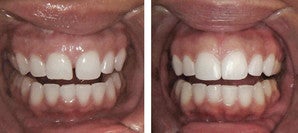 Diastema Bonding Before-and-After before 946217