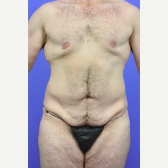 25-34 year old man treated with Breast Lift before 3145365