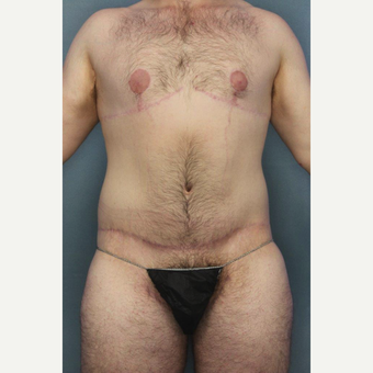 25-34 year old man treated with Breast Lift after 3145365