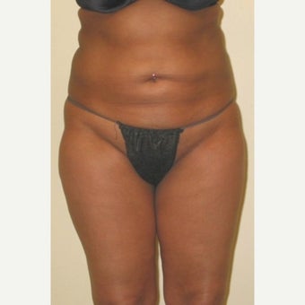 35-44 year old woman treated with Tummy Tuck before 1603488