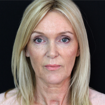 45-54 year old woman treated with Facelift before 3498635