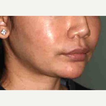 25-34 year old woman treated with a Custom Jawline Implant before 3599126
