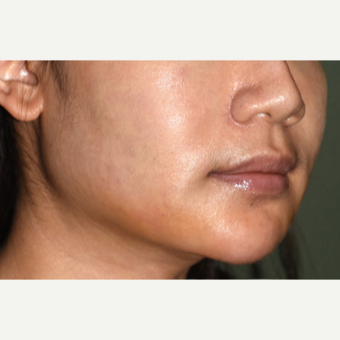 25-34 year old woman treated with a Custom Jawline Implant after 3599126