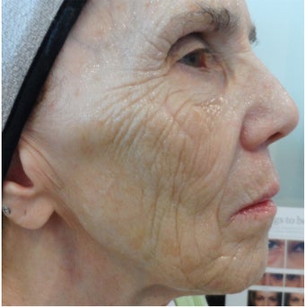 74 year old woman after 4 treatments with medical micro-needling using human growth factor serums before 1679500