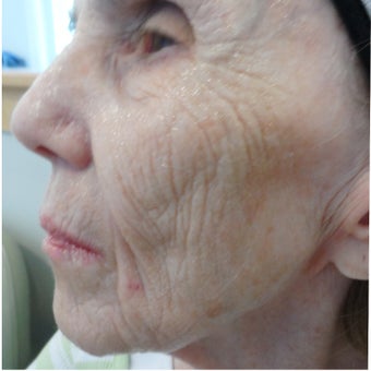 74 year old woman after 4 treatments with medical micro-needling using human growth factor serums 1679500