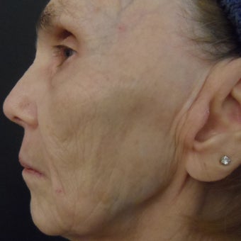 74 year old woman after 4 treatments with medical micro-needling using human growth factor serums 1679500