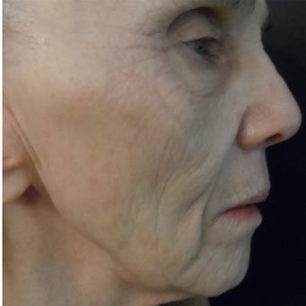 74 year old woman after 4 treatments with medical micro-needling using human growth factor serums after 1679500