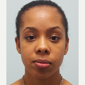 Lower blepharoplasty to treat under eye-bags on 24 year old woman. after 2593569