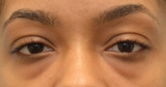 Lower blepharoplasty to treat under eye-bags on 24 year old woman. 2593569