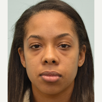 Lower blepharoplasty to treat under eye-bags on 24 year old woman. before 2593569