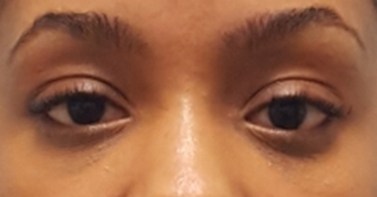 Lower blepharoplasty to treat under eye-bags on 24 year old woman. 2593569