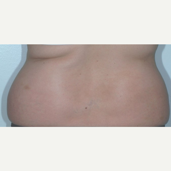 Liposuction before 3346235