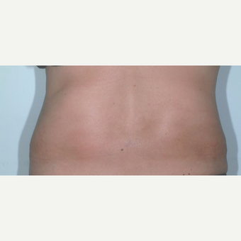 Liposuction after 3346235