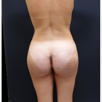35-44 year old woman treated with Butt Augmentation after 3234481
