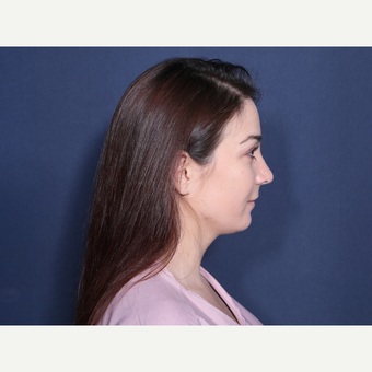 18-24 year old woman treated with Rhinoplasty (view 2 of 2) after 3776780