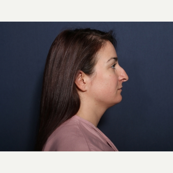 18-24 year old woman treated with Rhinoplasty (view 2 of 2) before 3776780