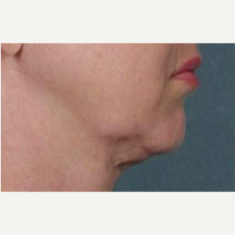Woman treated with Kybella before 2067013