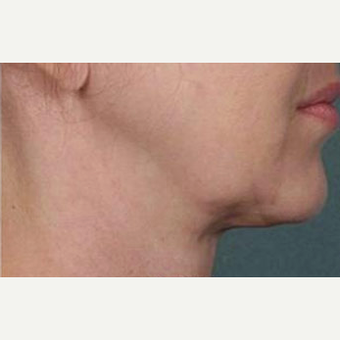 Woman treated with Kybella after 2067013