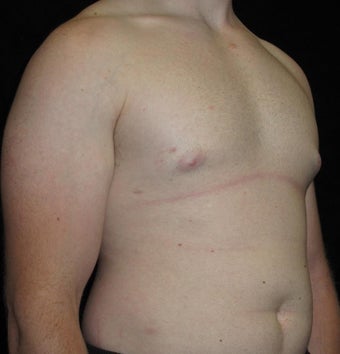 23 year old man treated with Male Breast Reduction 3093765