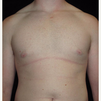 23 year old man treated with Male Breast Reduction after 3093765