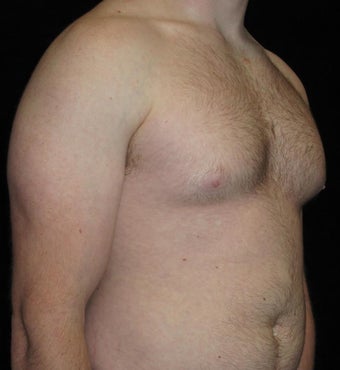 23 year old man treated with Male Breast Reduction 3093765