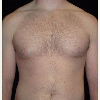 23 year old man treated with Male Breast Reduction before 3093765