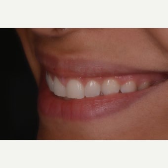 25-34 year old woman treated with Gum Lift before 1567113