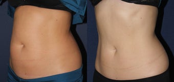 Before and After CoolSculpting before 1033830