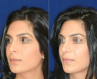 Nose Surgery before 1430788