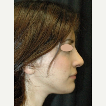25-34 year old woman treated with Rhinoplasty after 3783402