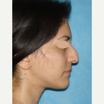 25-34 year old woman treated with Rhinoplasty before 3783402