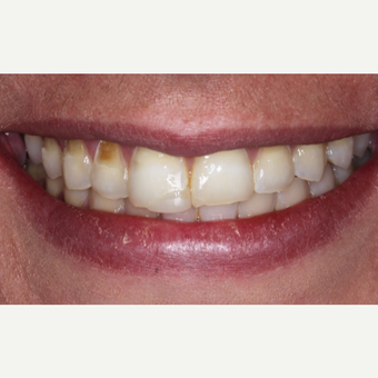 45-54 year old woman treated with Dental Bonding before 3629766