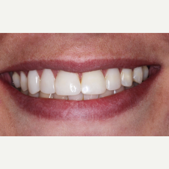 45-54 year old woman treated with Dental Bonding after 3629766