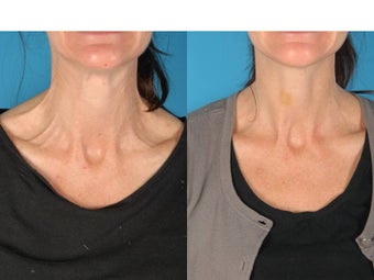 Botox for Neck Bands before 686137
