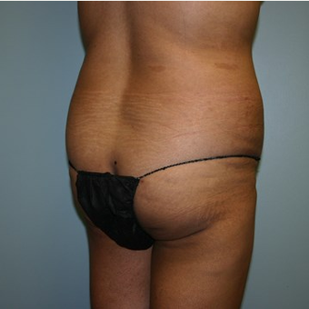 Brazilian Butt Lift before 3667632