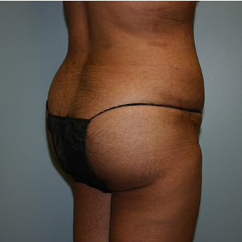 Brazilian Butt Lift after 3667632