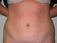 liposuction after 269325