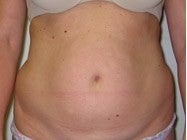 liposuction before 269325