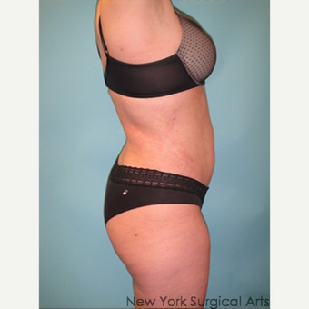 35-44 year old woman treated with Smart Lipo after 3437406