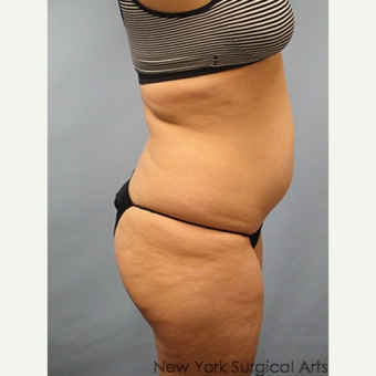 35-44 year old woman treated with Smart Lipo before 3437406