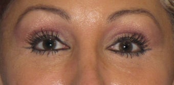 Lower Lid Blepharoplasty, with Fat Grafting up Upper and Lower Lids after 1047188