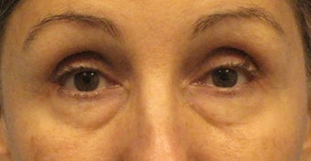 Lower Lid Blepharoplasty, with Fat Grafting up Upper and Lower Lids before 1047188