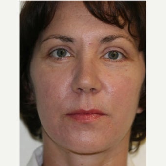 45 year old woman treated with Fractional Laser after 2062955