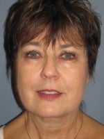 55-64 year old woman treated with Neck Lift after 3103926