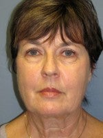 55-64 year old woman treated with Neck Lift before 3103926