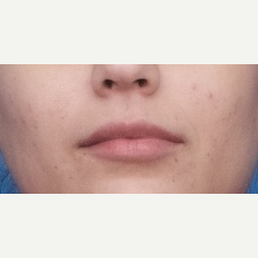 18-24 year old woman treated with Injectable Fillers after 3764298