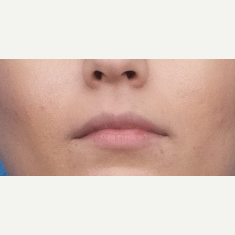 18-24 year old woman treated with Injectable Fillers before 3764298