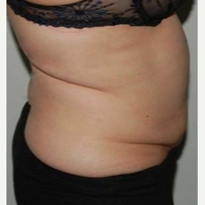45-54 year old woman treated with CoolSculpting 1570556