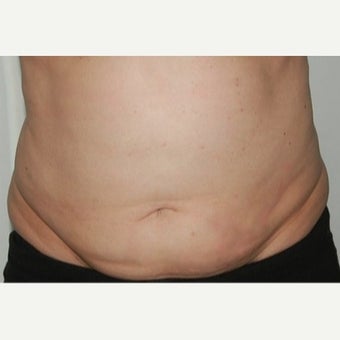 45-54 year old woman treated with CoolSculpting before 1570556