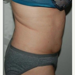 45-54 year old woman treated with CoolSculpting 1570556